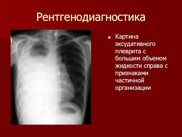 Рентгенодиагностика Картина эксудативного плеврита с большим объемом жидкости справа с признаками частичной организации