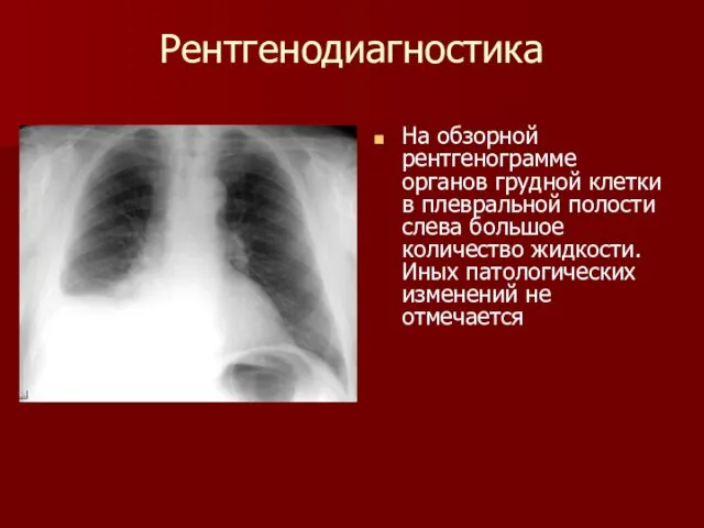 Рентгенодиагностика На обзорной рентгенограмме органов грудной клетки в плевральной полости слева