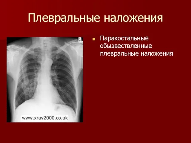 Плевральные наложения Паракостальные обызвествленные плевральные наложения