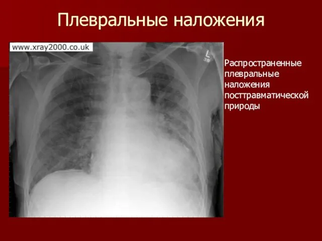 Плевральные наложения Распространенные плевральные наложения посттравматической природы