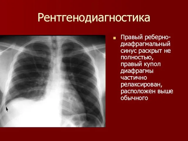 Рентгенодиагностика Правый реберно-диафрагмальный синус раскрыт не полностью, правый купол диафрагмы частично релаксирован, расположен выше обычного