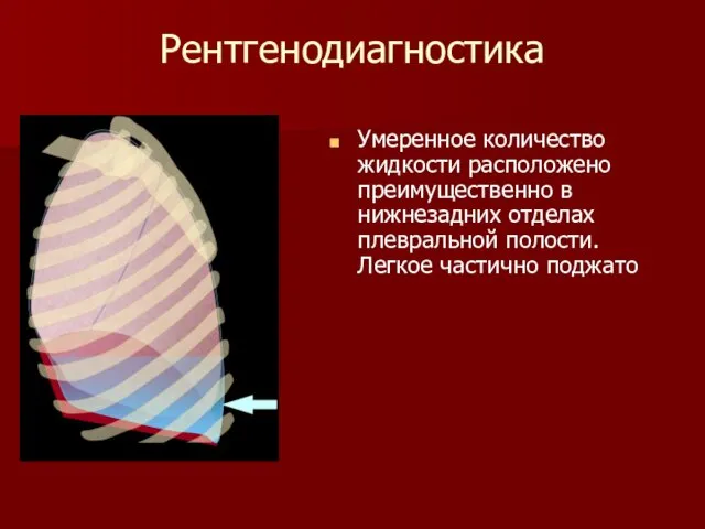 Рентгенодиагностика Умеренное количество жидкости расположено преимущественно в нижнезадних отделах плевральной полости. Легкое частично поджато