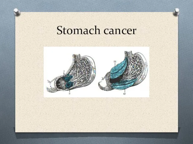 Stomach cancer