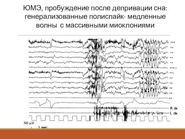 ЮМЭ, пробуждение после депривации сна: генерализованные полиспайк- медленные волны с массивными миоклониями