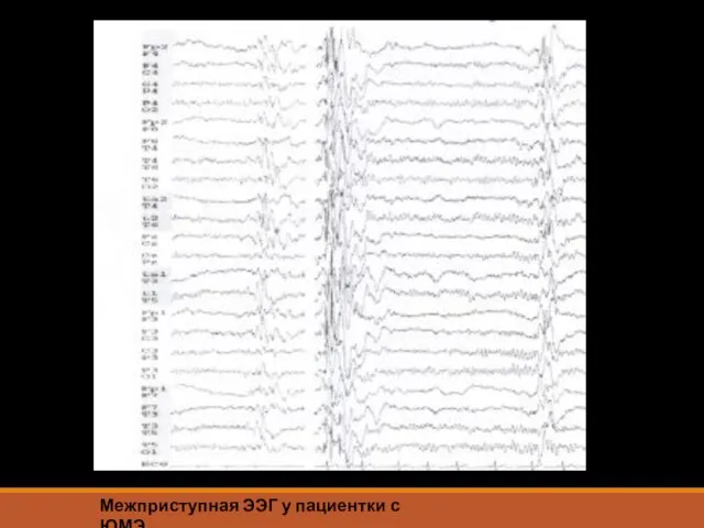 Межприступная ЭЭГ у пациентки с ЮМЭ