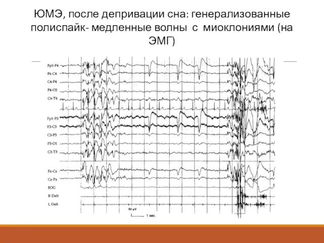 ЮМЭ, после депривации сна: генерализованные полиспайк- медленные волны с миоклониями (на ЭМГ)