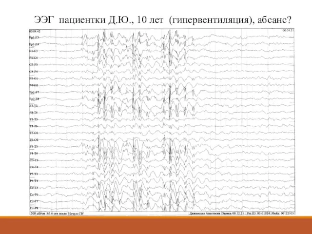 ЭЭГ пациентки Д.Ю., 10 лет (гипервентиляция), абсанс?