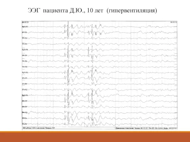 ЭЭГ пациента Д.Ю., 10 лет (гипервентиляция)