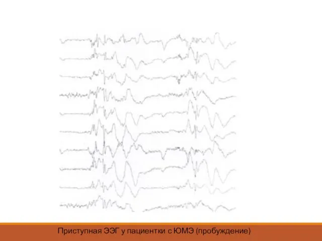 Приступная ЭЭГ у пациентки с ЮМЭ (пробуждение)