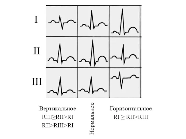 Вертикальное RIII≥RII>RI RII>RIII>RI Горизонтальное RI ≥ RII>RIII Нормальное I II III