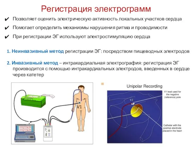 Регистрация электрограмм Позволяет оценить электрическую активность локальных участков сердца Помогает определить