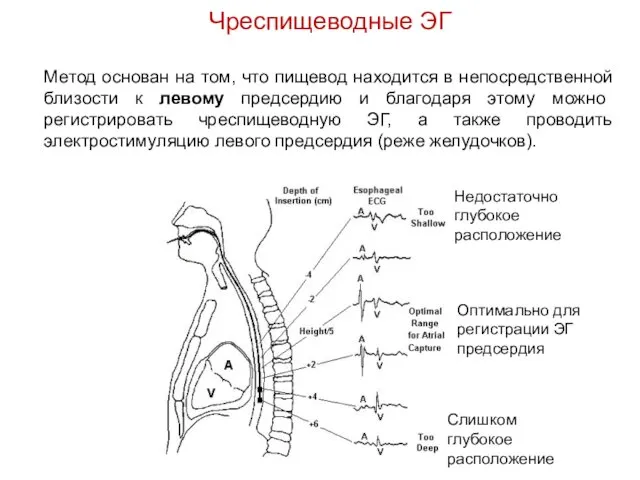 Чреспищеводные ЭГ Метод основан на том, что пищевод находится в непосредственной