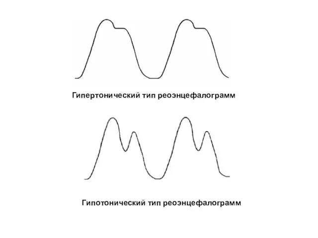 Гипотонический тип реоэнцефалограмм Гипертонический тип реоэнцефалограмм
