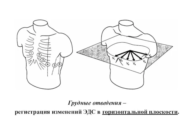 Грудные отведения – регистрация изменений ЭДС в горизонтальной плоскости.
