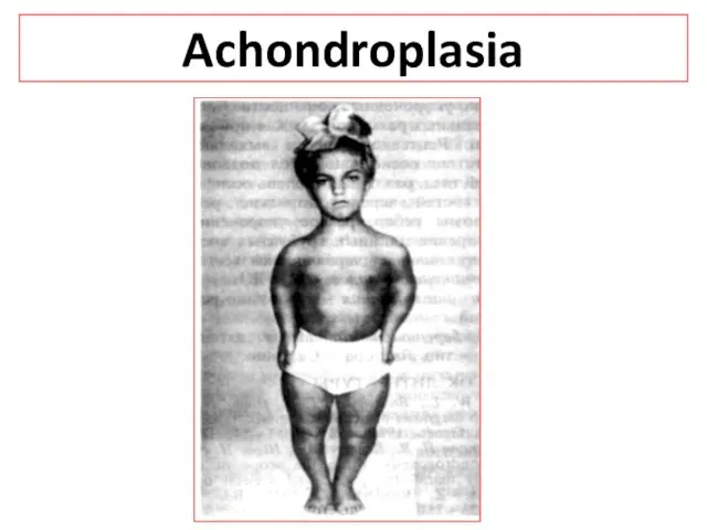 Achondroplasia