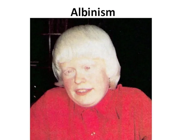 Albinism