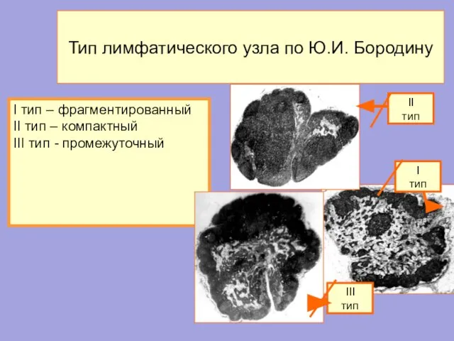 Тип лимфатического узла по Ю.И. Бородину I тип – фрагментированный II