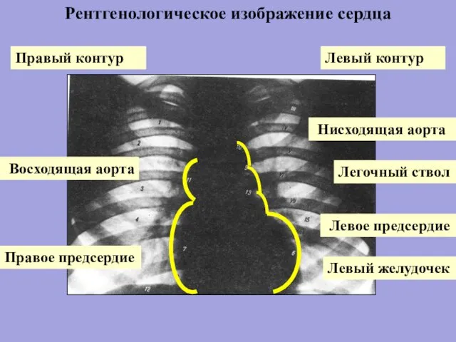 Правое предсердие Восходящая аорта Нисходящая аорта Легочный ствол Левое предсердие Левый