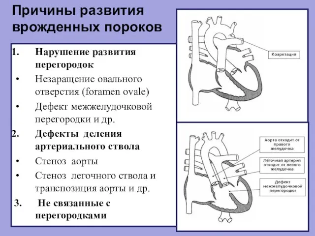 Причины развития врожденных пороков Нарушение развития перегородок Незаращение овального отверстия (foramen