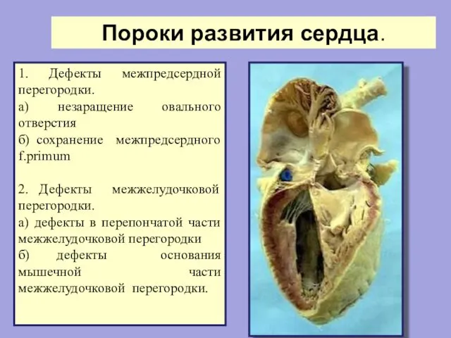 Пороки развития сердца. 1. Дефекты межпредсердной перегородки. а) незаращение овального отверстия