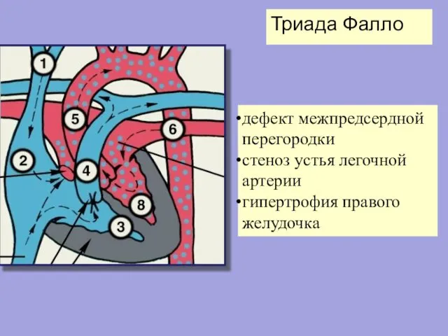 дефект межпредсердной перегородки стеноз устья легочной артерии гипертрофия правого желудочка Триада Фалло