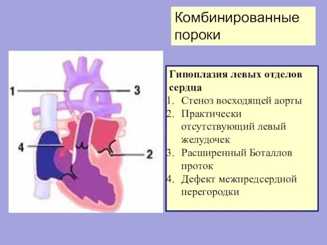 Гипоплазия левых отделов сердца Стеноз восходящей аорты Практически отсутствующий левый желудочек