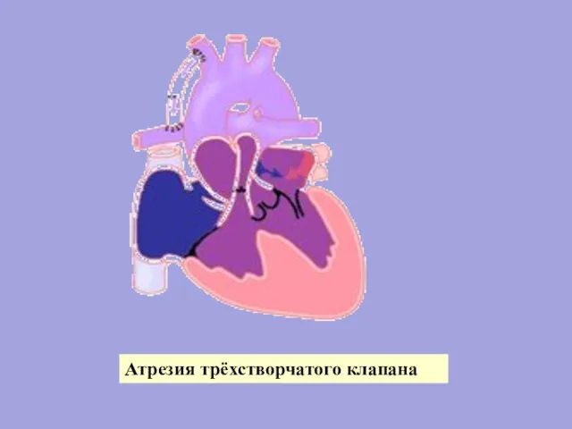 Атрезия трёхстворчатого клапана