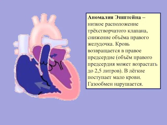 Аномалия Эпштейна – низкое расположение трёхстворчатого клапана, снижение объёма правого желудочка.