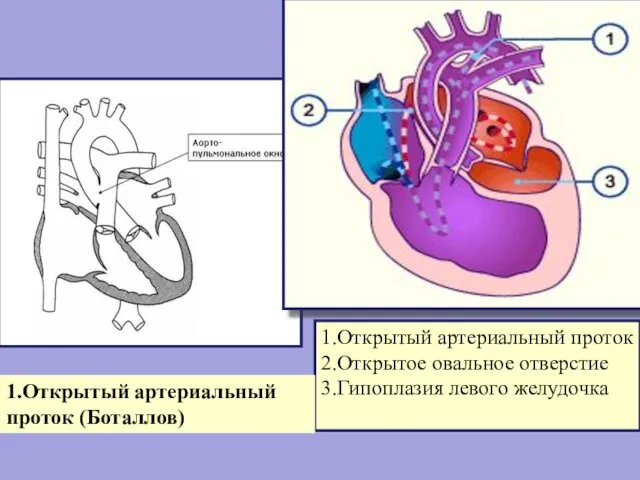 1.Открытый артериальный проток 2.Открытое овальное отверстие 3.Гипоплазия левого желудочка 1.Открытый артериальный проток (Боталлов)