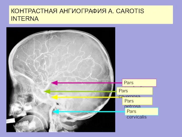 КОНТРАСТНАЯ АНГИОГРАФИЯ A. CAROTIS INTERNA Pars cerebralis Pars cavernosa Pars petrosa Pars cervicalis