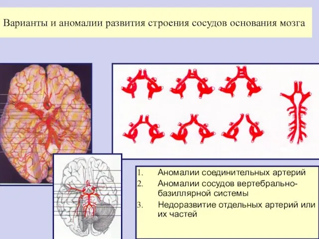 Варианты и аномалии развития строения сосудов основания мозга Аномалии соединительных артерий