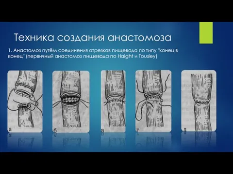 Техника создания анастомоза 1. Анастомоз путём соединения отрезков пищевода по типу