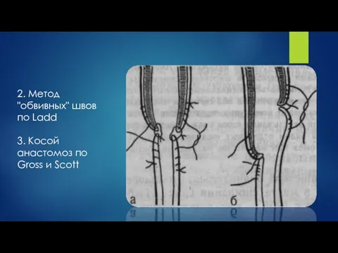 2. Метод "обвивных" швов по Ladd 3. Косой анастомоз по Gross и Scott