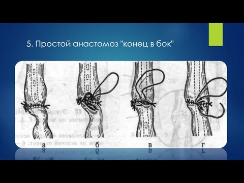 5. Простой анастомоз "конец в бок"