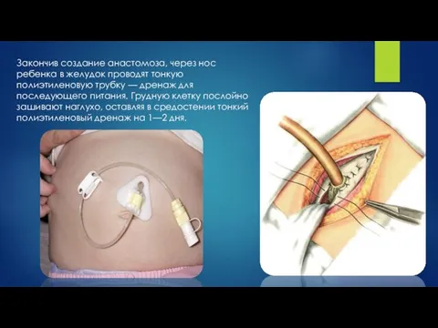 Закончив создание анастомоза, через нос ребенка в желудок проводят тонкую полиэтиленовую