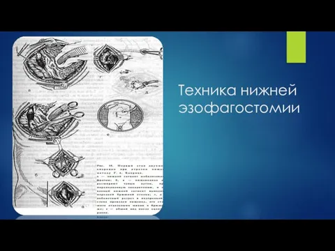 Техника нижней эзофагостомии