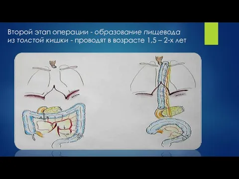 Второй этап операции - образование пищевода из толстой кишки - проводят