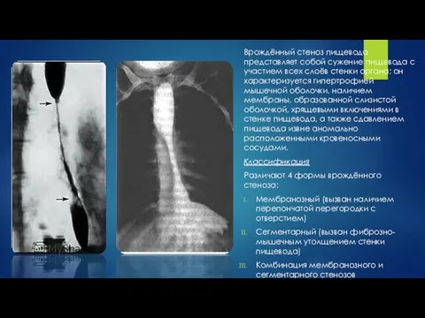 Врождённый стеноз пищевода представляет собой сужение пищевода с участием всех слоёв