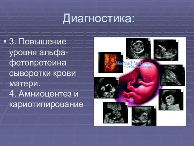 Диагностика: 3. Повышение уровня альфа-фетопротеина сыворотки крови матери. 4. Амниоцентез и кариотипирование