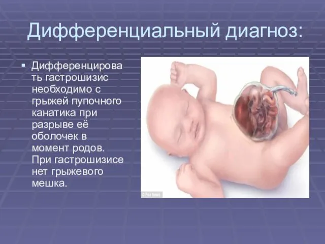 Дифференциальный диагноз: Дифференцировать гастрошизис необходимо с грыжей пупочного канатика при разрыве