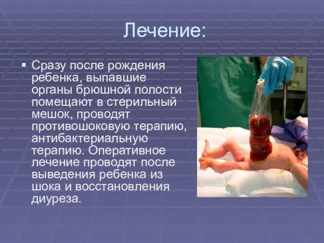 Лечение: Сразу после рождения ребенка, выпавшие органы брюшной полости помещают в