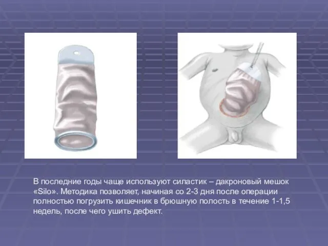 В последние годы чаще используют силастик – дакроновый мешок «Silo». Методика