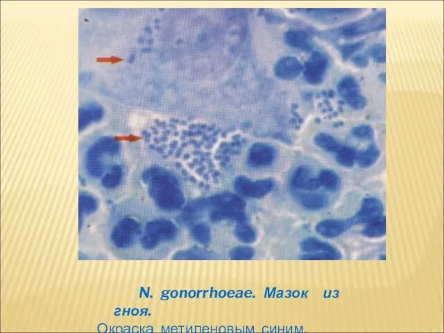 N. gonorrhoeae. Мазок из гноя. Окраска метиленовым синим.