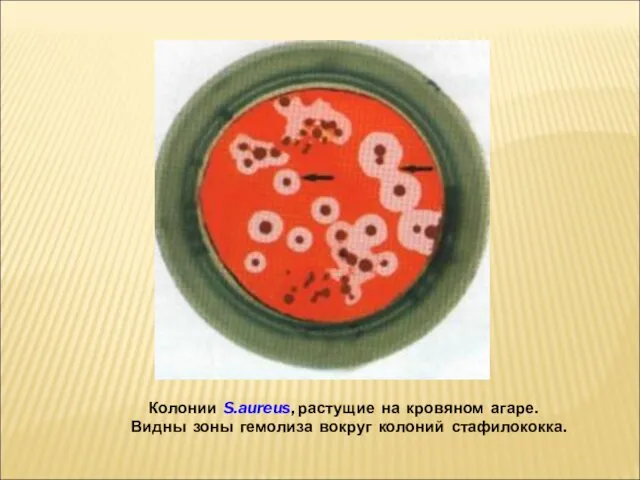 Колонии S.aureus, растущие на кровяном агаре. Видны зоны гемолиза вокруг колоний стафилококка.