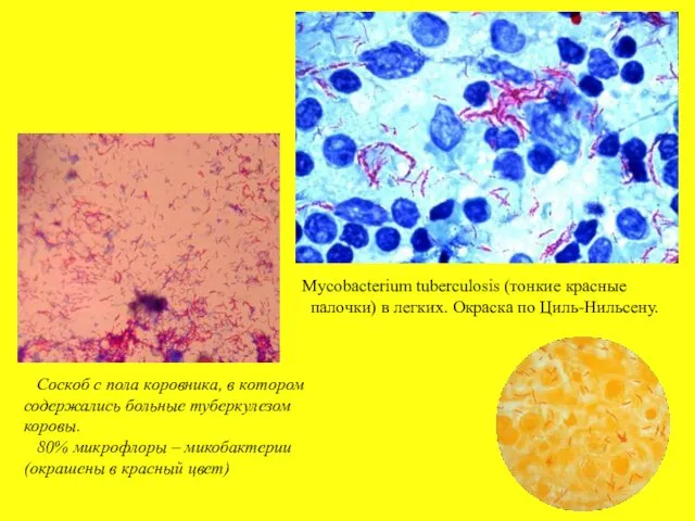 Mycobacterium tuberculosis (тонкие красные палочки) в легких. Окраска по Циль-Нильсену. Соскоб