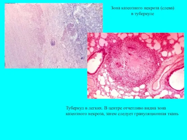 Зона казеозного некроза (слева) в туберкуле Туберкул в легких. В центре