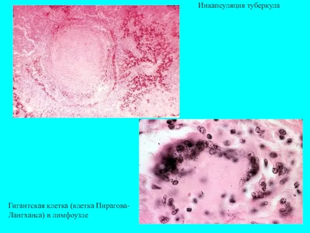 Инкапсуляция туберкула Гигантская клетка (клетка Пирагова-Лангханса) в лимфоузле