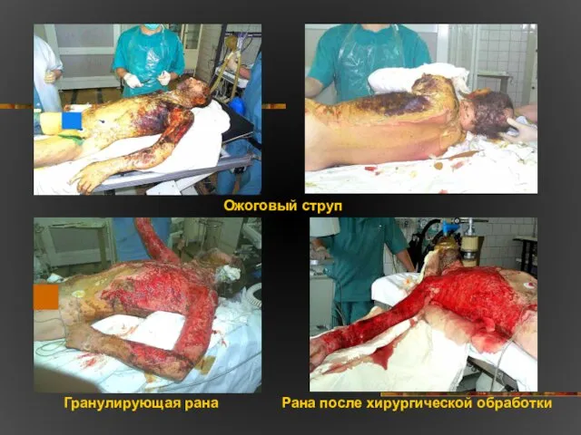 Ожоговый струп Гранулирующая рана Рана после хирургической обработки