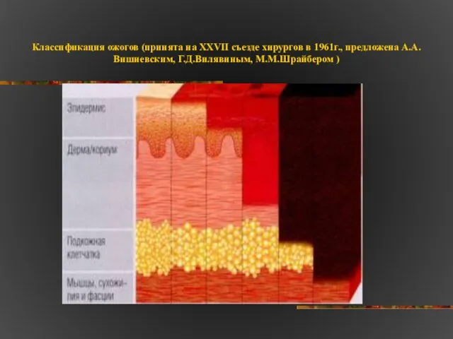 Классификация ожогов (принята на XXVII съезде хирургов в 1961г., предложена А.А.Вишневским, Г.Д.Вилявиным, М.М.Шрайбером )