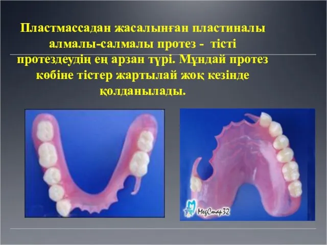 Пластмассадан жасалынған пластиналы алмалы-салмалы протез - тісті протездеудің ең арзан түрі.